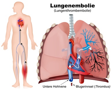 Lungenembolie erklärt